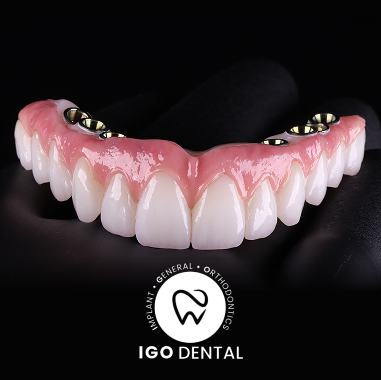 Hybrid Implant Bridge