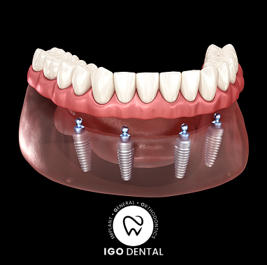 Zirconia Implant Bridge