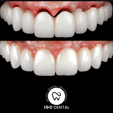 Porcelain Implant Bridge